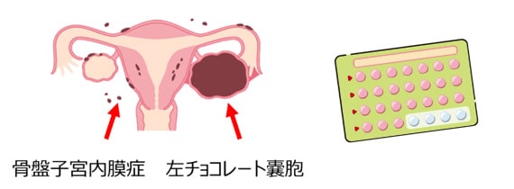 骨盤子宮内膜症　左チョコレート嚢胞