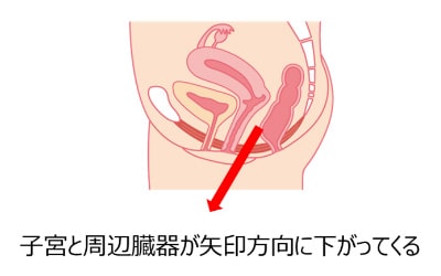 子宮と周辺臓器が矢印方向に下がってくる